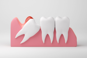 How to Treat a Wisdom Tooth Infection Your Guide to Relief