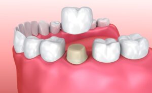 Recovery After a Dental Crown Treatment