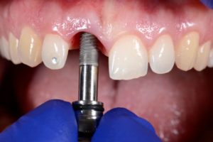 How Dental Implants can Improve Your Health and Confidence