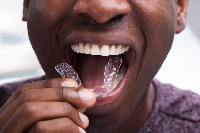 What Do Invisalign Braces Cost? Are They Worth It?