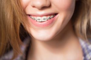 What is the difference between cosmetic braces and orthodontic braces
