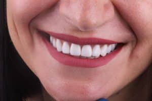 teeth whitening treatments