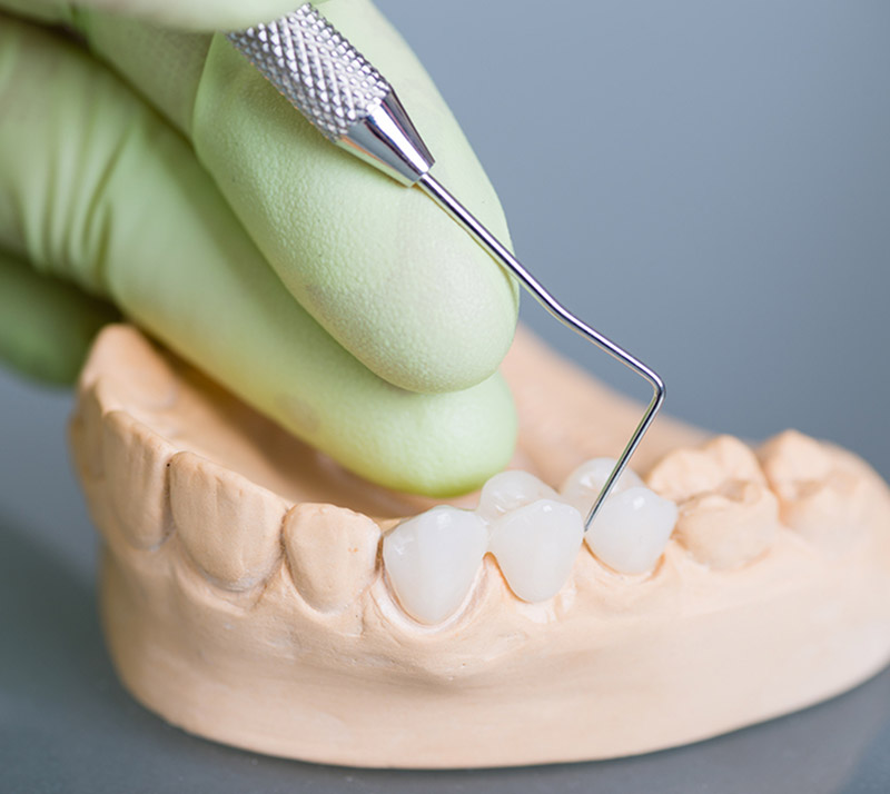 dental crowns in se calgary