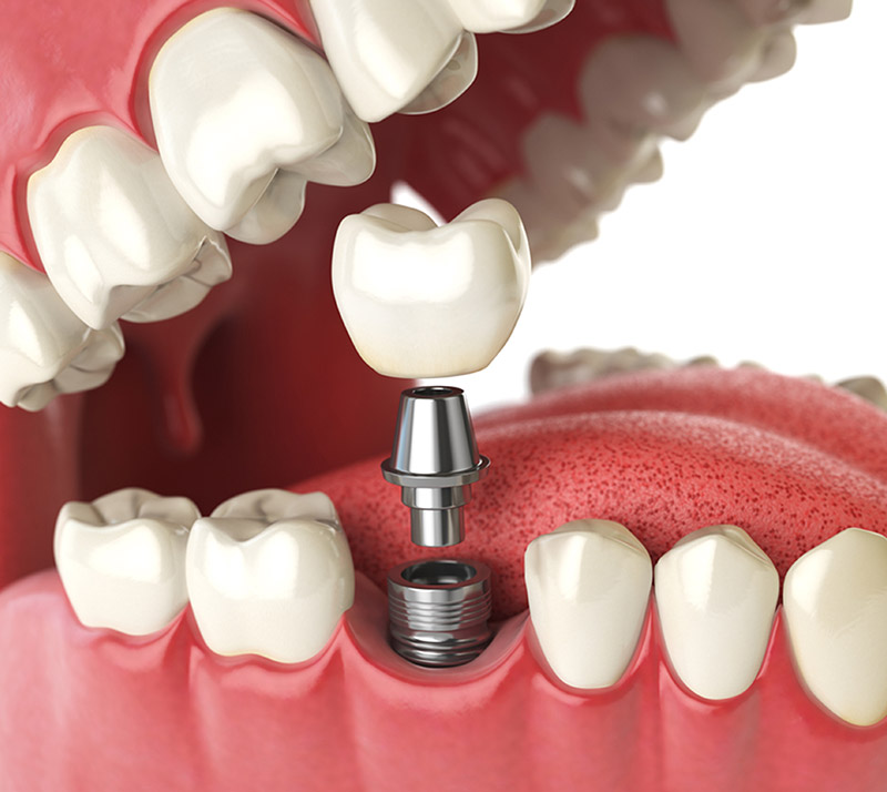 dental implants near you in mckenzie towne