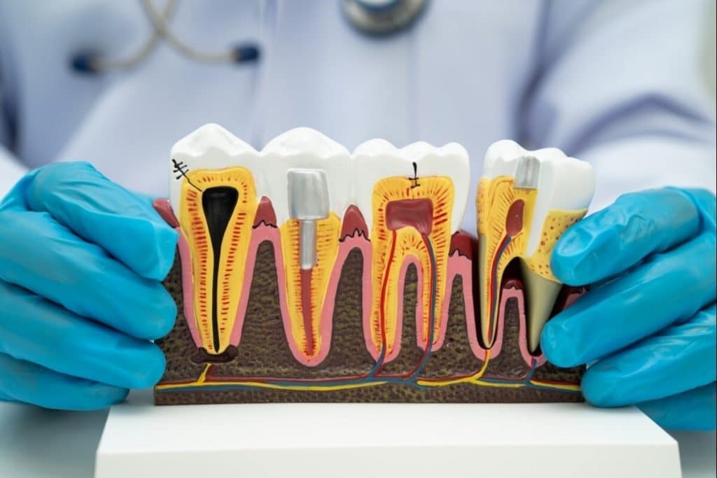 root canal therapy in se calgary
