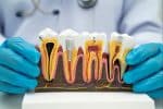 root canal therapy in se calgary