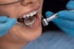 insurance and dental implants coverage guide 2025