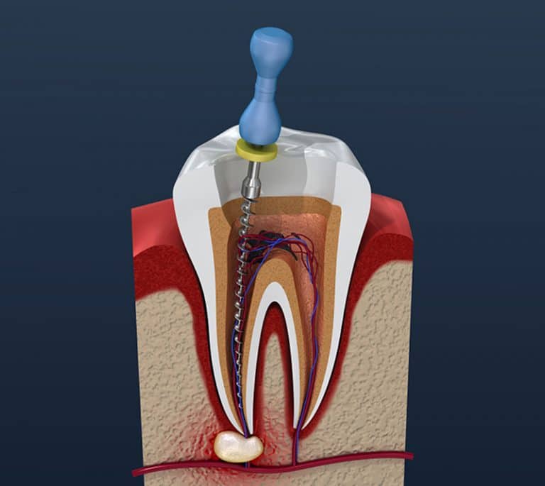 root canal treatment demo
