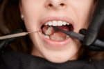a lady is having tooth extraction treatment