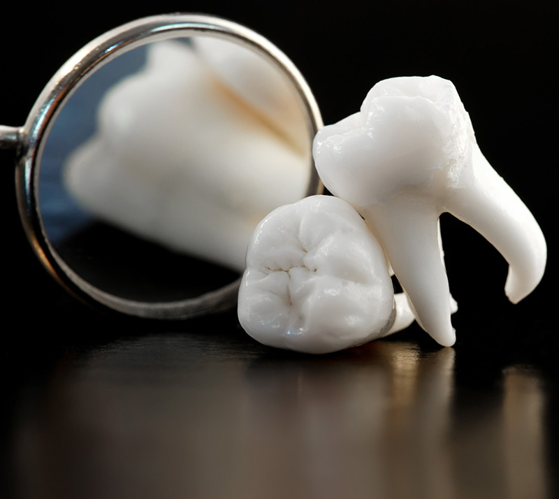 wisdom tooth extractions near you in mckenzie towne